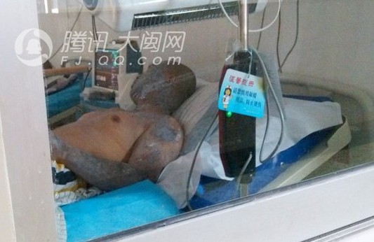 燒傷者